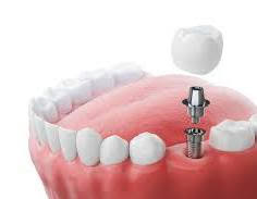 Implant Dentistry