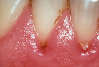 gingivitis gingivitis