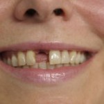 Missing teeth